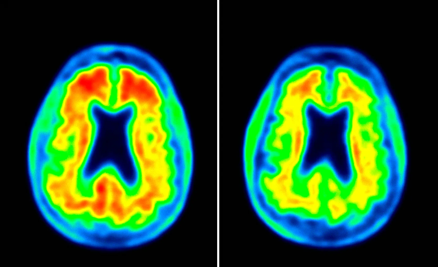 New Hope for Alzheimer’s Treatment in the UK